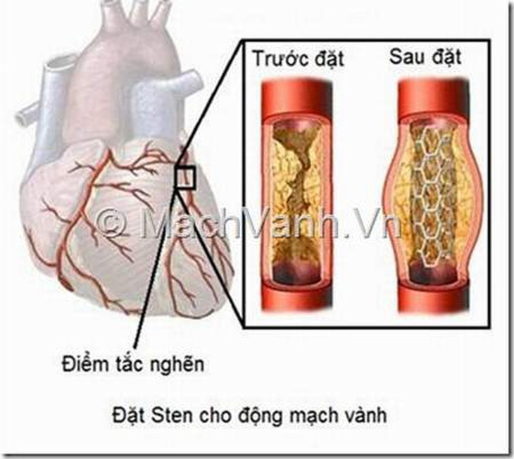 Nguyên nhân gây bệnh mạch vành 1